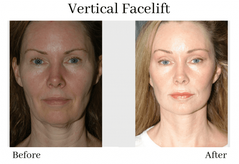 How The Vertical Facelift Is Revolutionizing Facial Rejuvenation Beverly Hills Facelift Institute