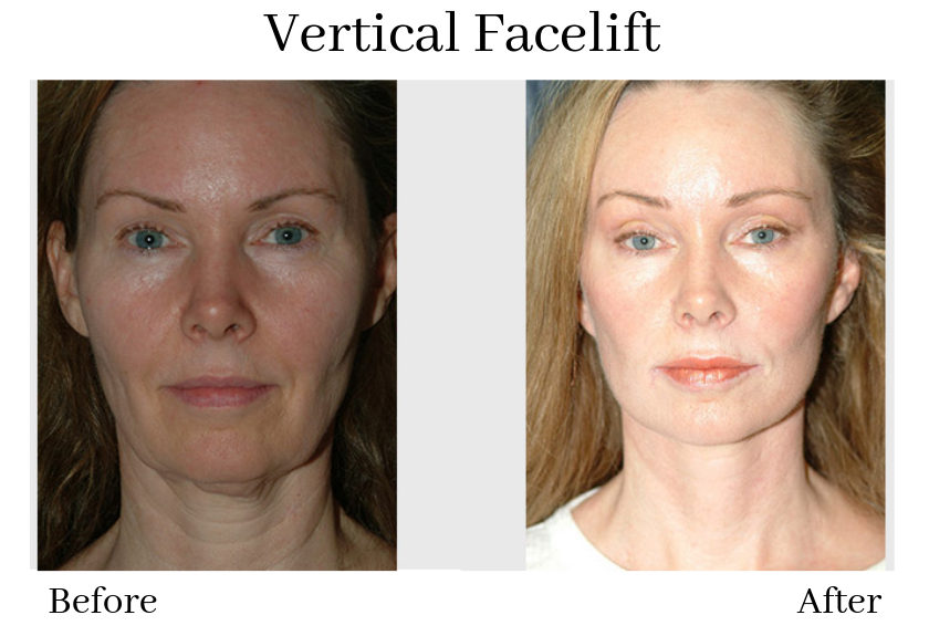 What is The Natural Facelift?, Blog