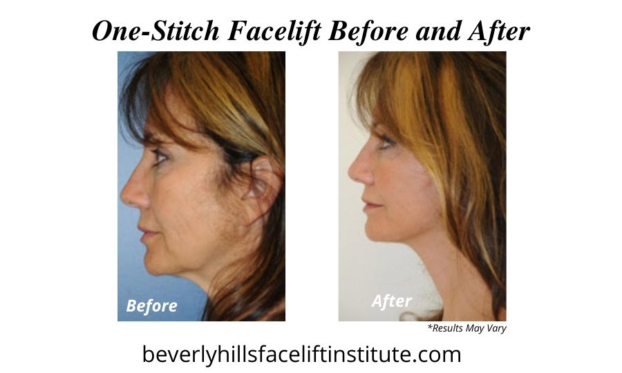  A woman before and after her one-stitch facelift.