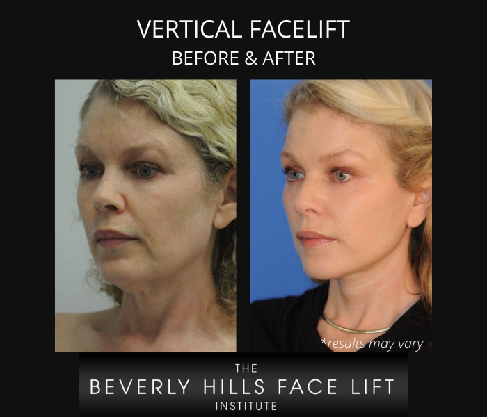 Before and after image showing the results of a vertical facelift performed in Beverly Hills, CA.