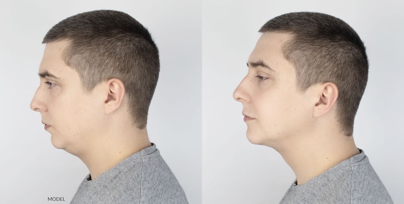 Side profile before and after of a young man who had a double chin treatment