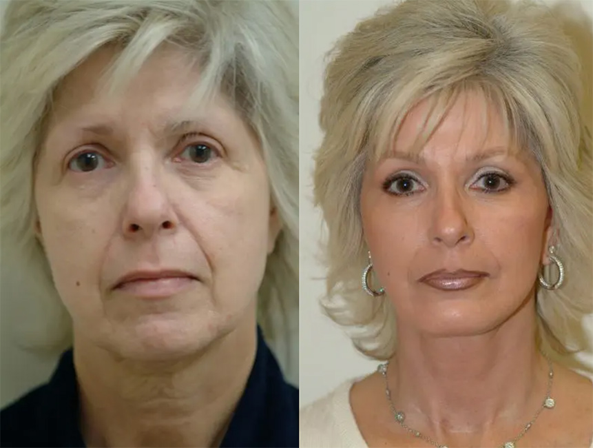 before and after pictures of a facelift patient in Beverly Hills